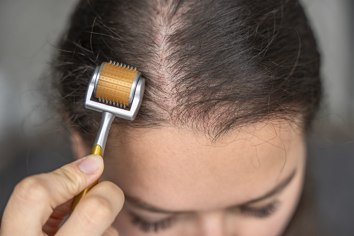 Hair Loss Derma Roller