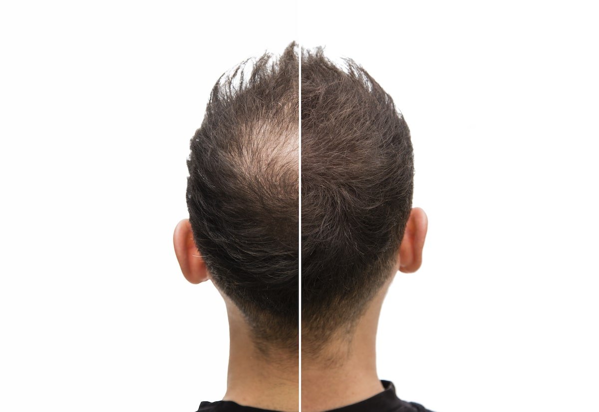 Scalp-Micropigmentation-min